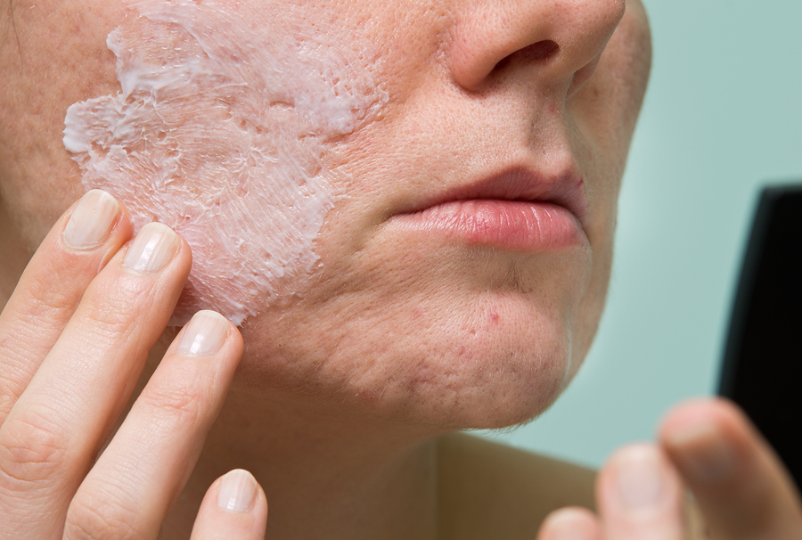 Chickenpox and Shingles Scars