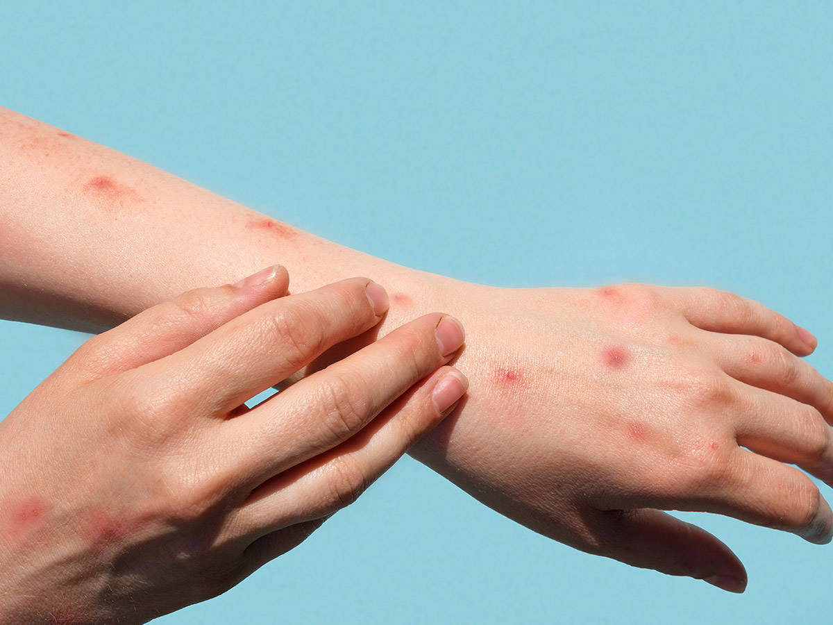 Adult Chickenpox Symptoms