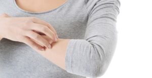 a woman who knows about urticaria and eczema