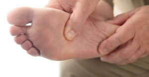 a man with athletes foot