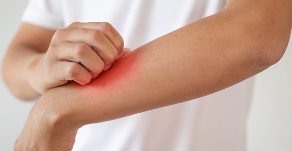 a woman with heat rash
