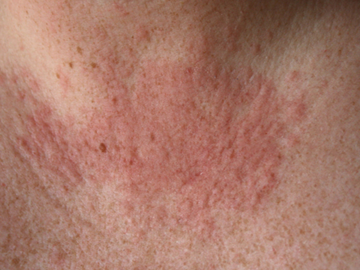 What are Symptoms of Heat Rash?