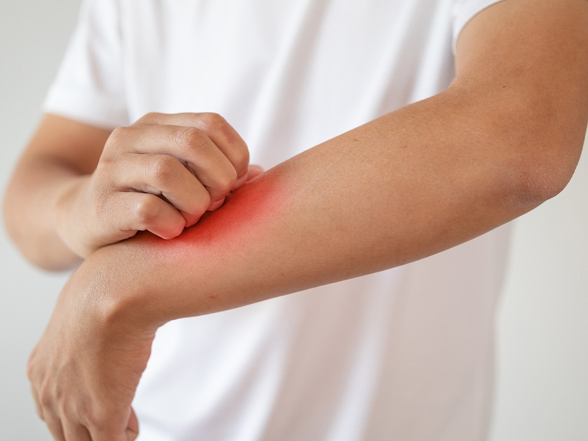 What is Heat Rash?