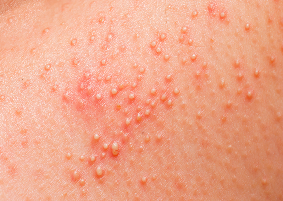 What Does Heat Rash Look Like?