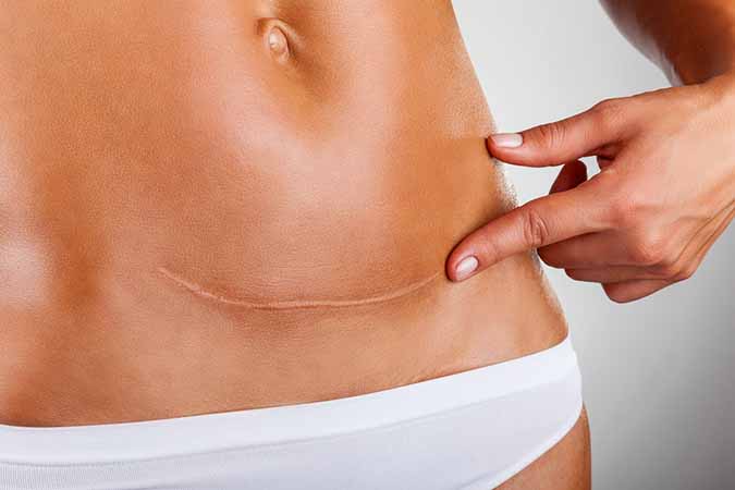 Cesarean Section