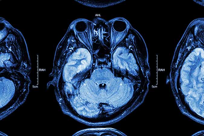 Epilepsy Surgery