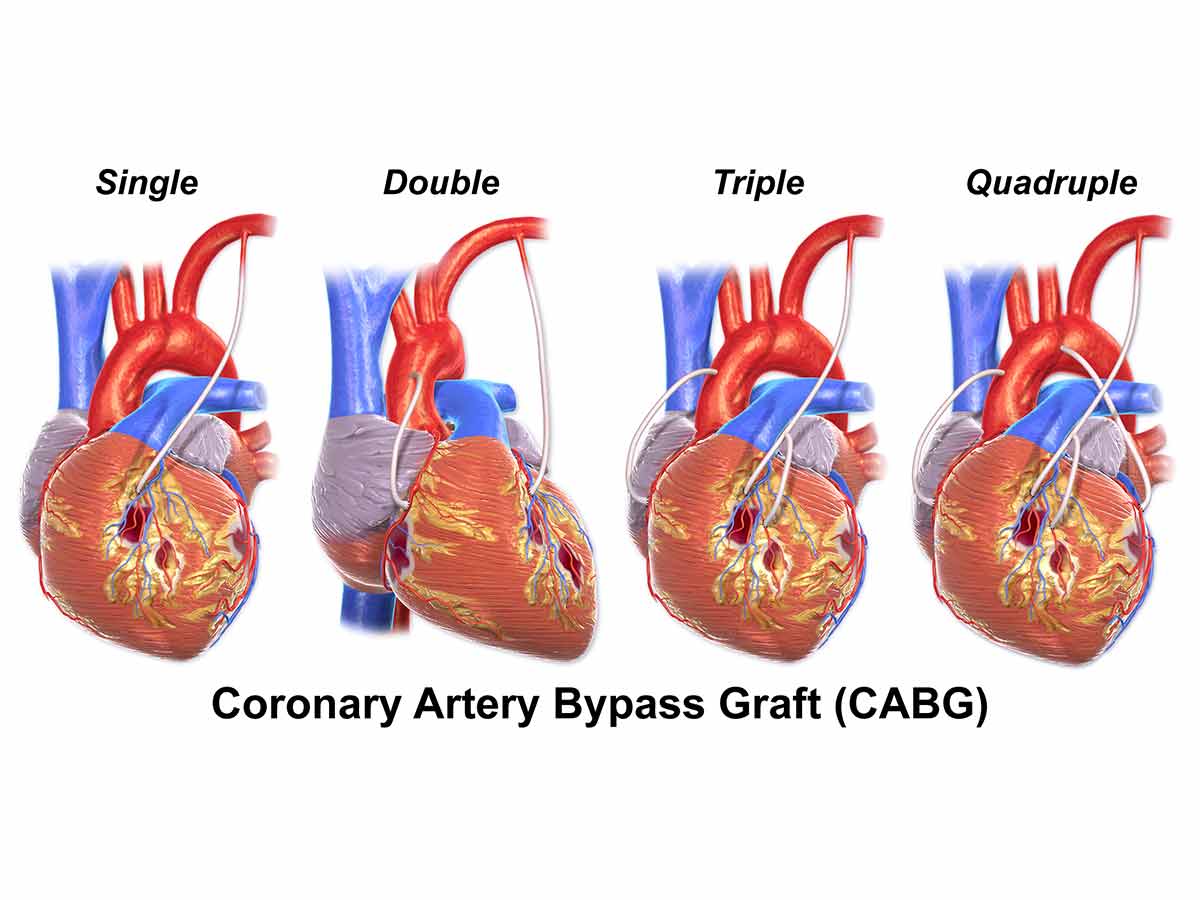 Coronary Artery Bypass Graft