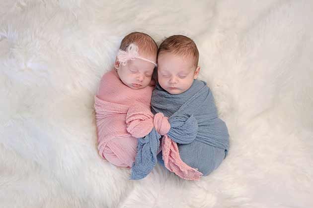 Conjoined Twin Separation
