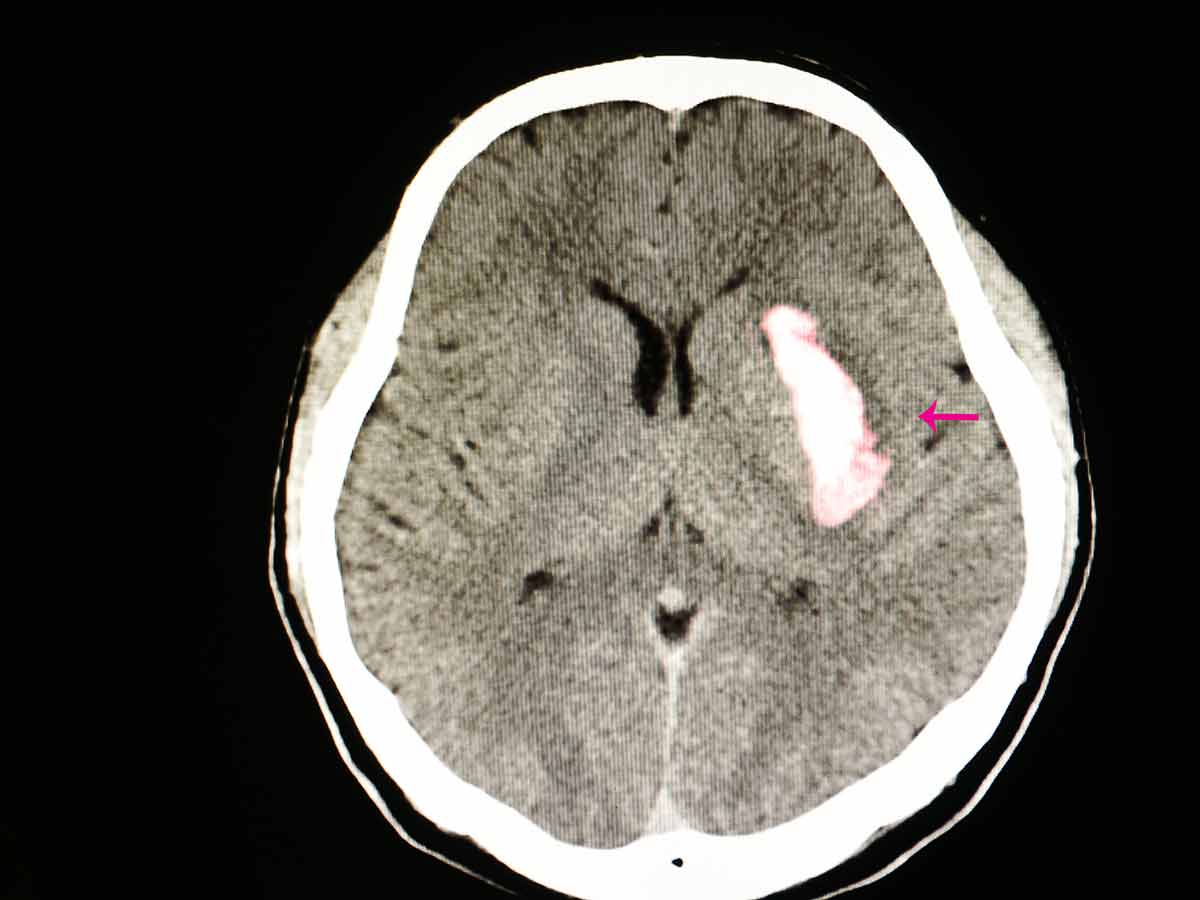 Craniectomy
