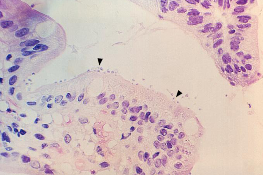 Cryptosporidiosis