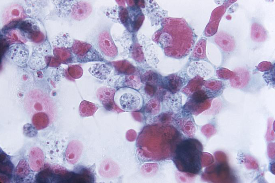 Naegleriasis and Acanthamoebiasis