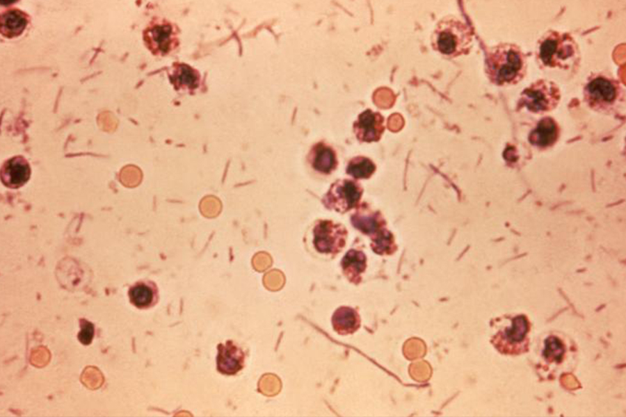 Shigellosis