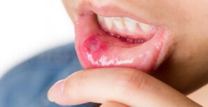 a man with a canker sore