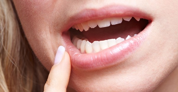 a woman pointing at a canker sore sign