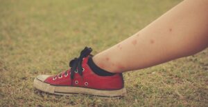 A child's leg covered in bug bites.