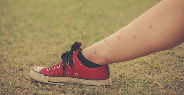 A child's leg covered in bug bites.