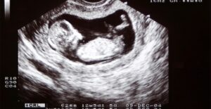 4D ultrasounds