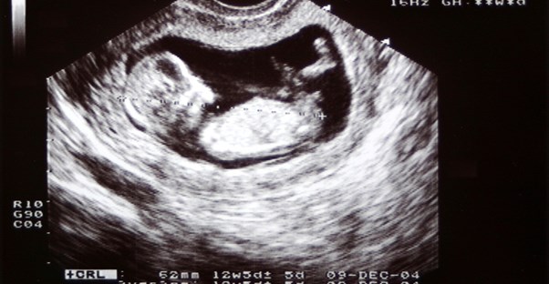 4D ultrasounds