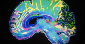 What causes OCD?
