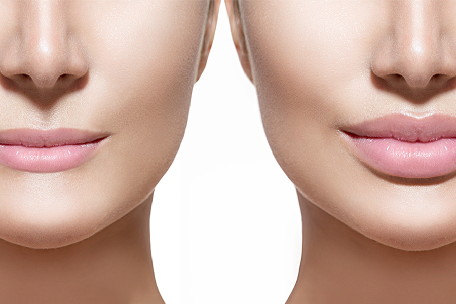 Silicone Lip Injections