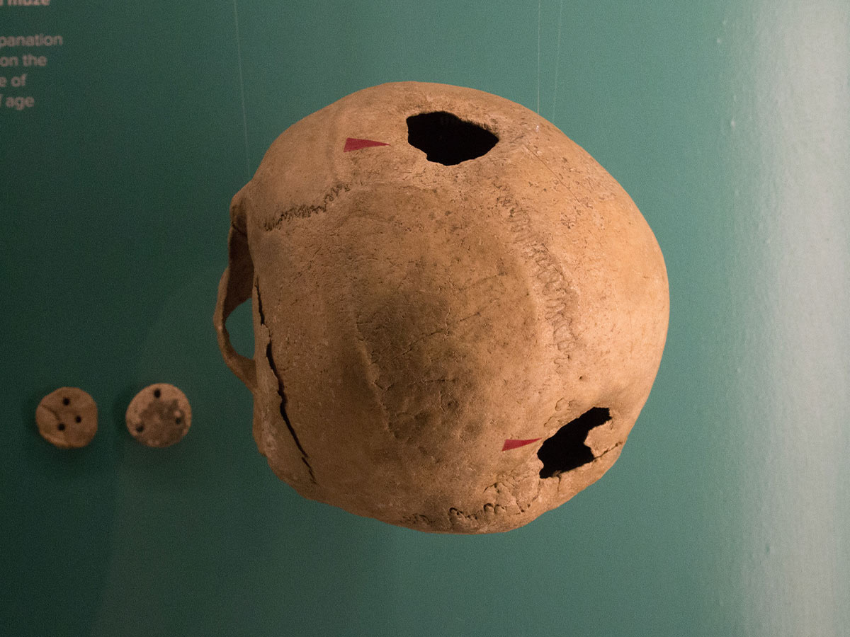 Trepanning