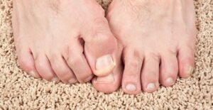 Severe toenail fungus