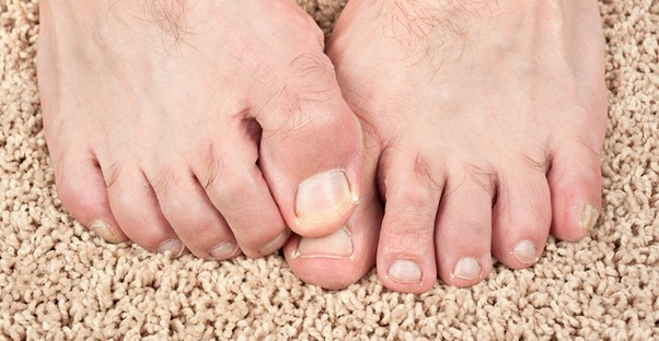 Severe toenail fungus
