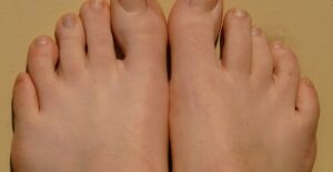 The more informed you are about toe fungus, the more effectively you can battle it.