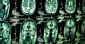 Understanding glioblastoma