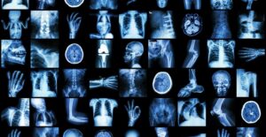 Glioblastoma and other tumors