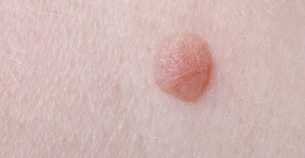 Why do warts form?
