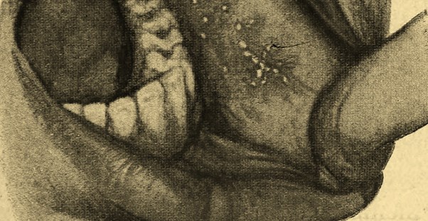 Ancient diseases