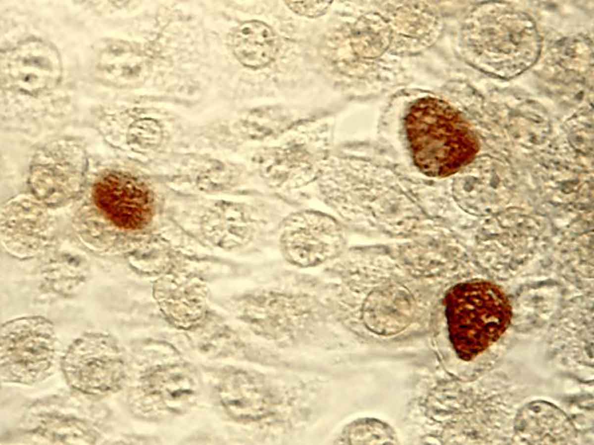 Chlamydia