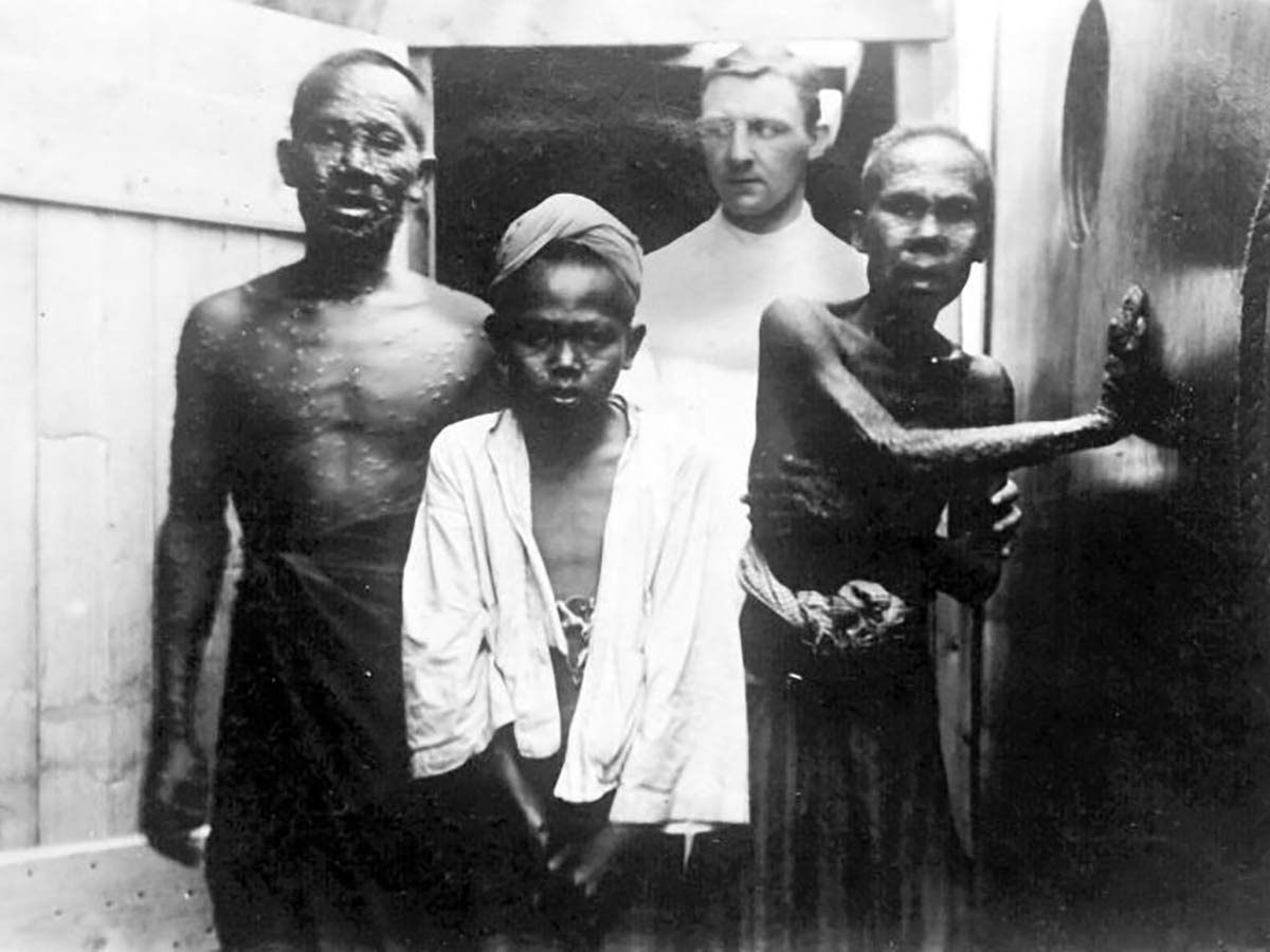 Smallpox
