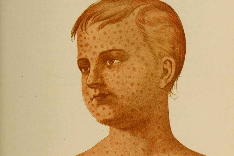 Rubella