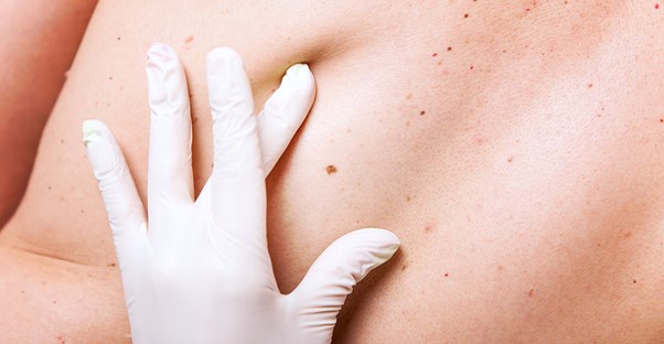 A basal cell carcinoma