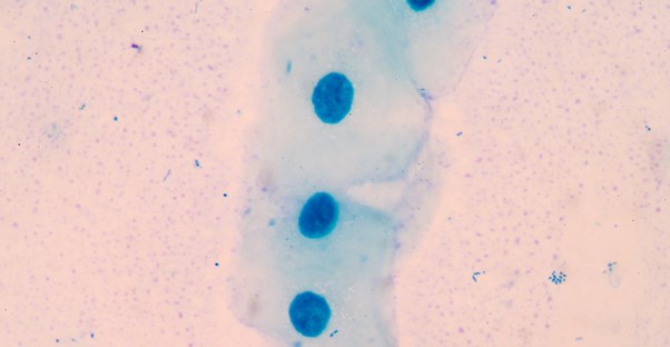 A squamous cell carcinoma