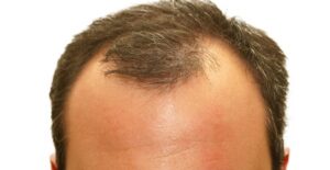 A man longs for hair restoration