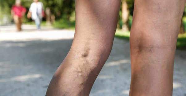 A womans deep vein thrombosis