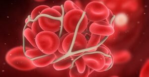 A thrombus forms.