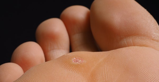 A plantar wart in its natural habitat