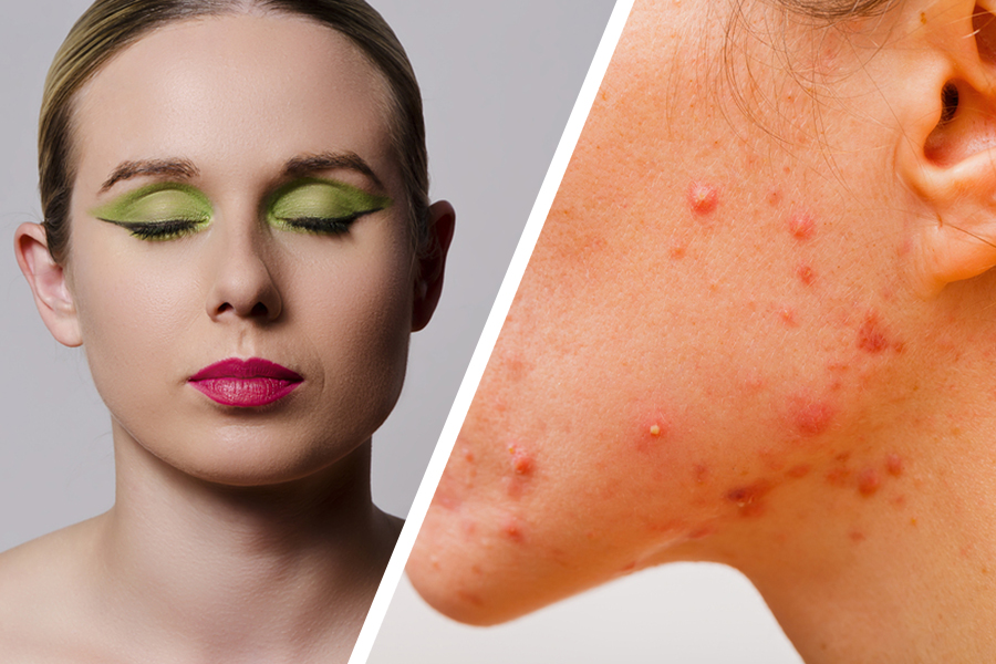 Sleeping In Makeup Causes Breakouts