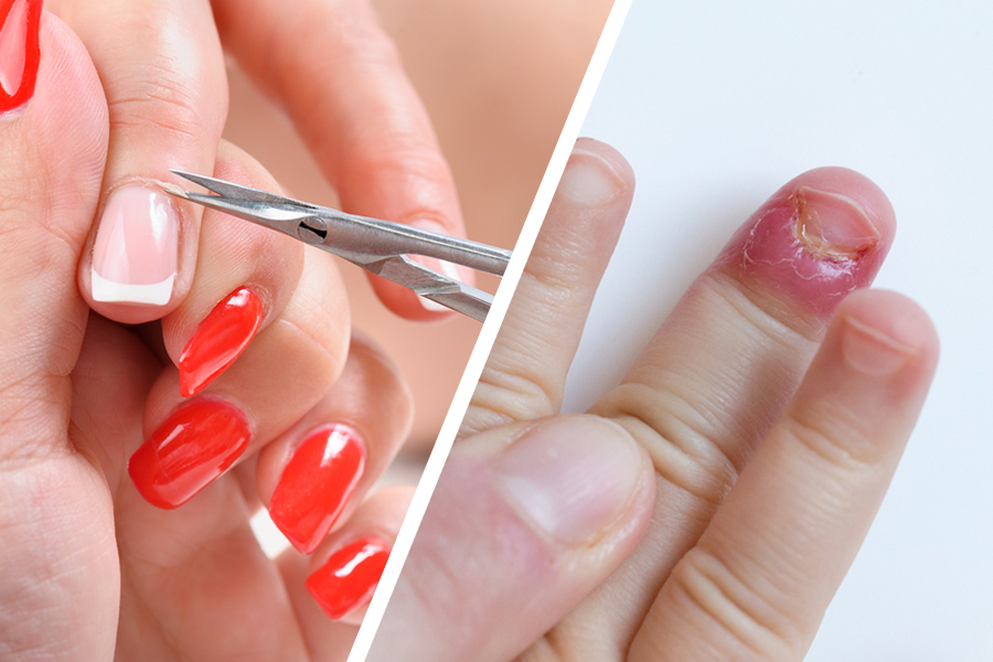 Cutting Cuticles Can Cause Infection