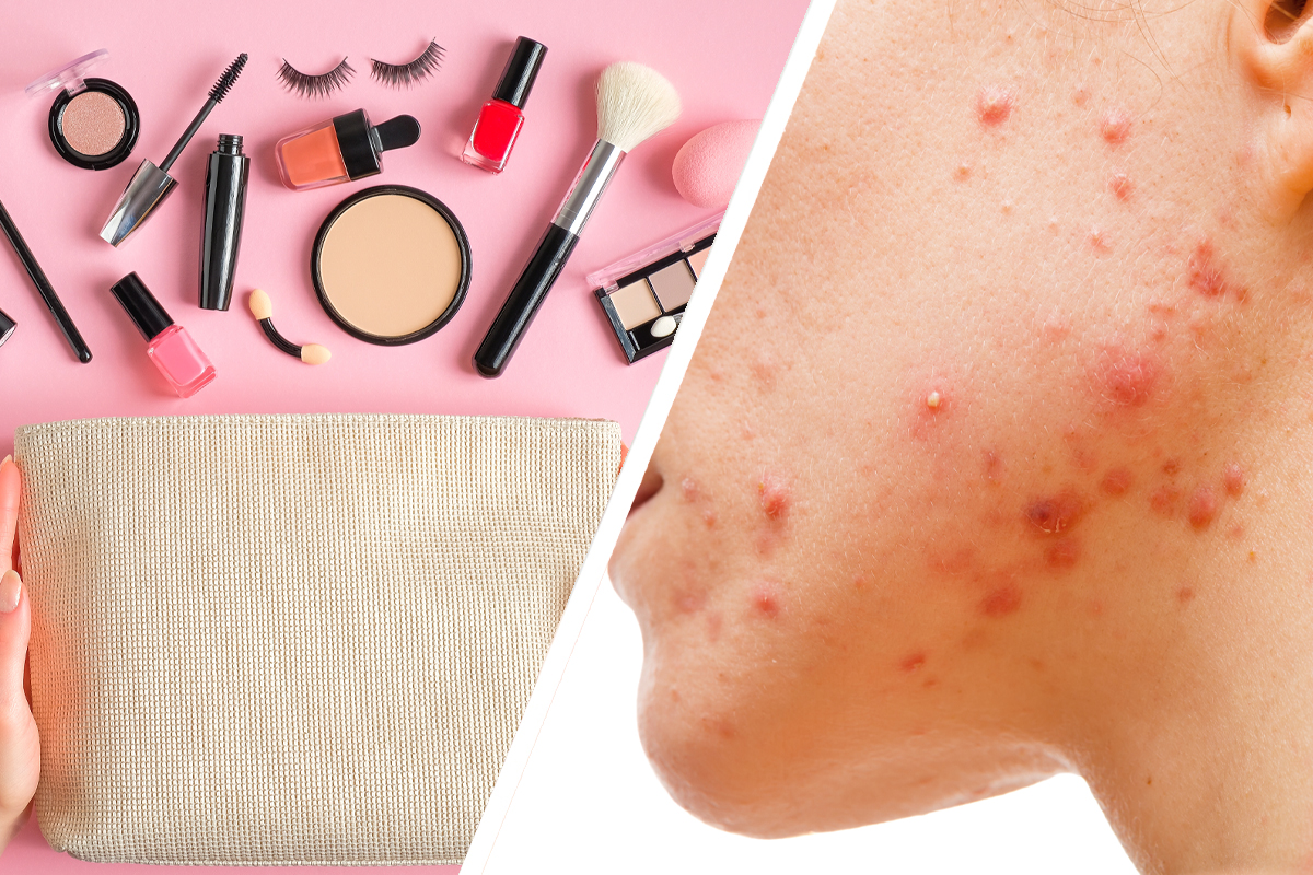 Expired Makeup Causes Acne
