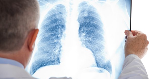 A doctor is concerned about a lung plug