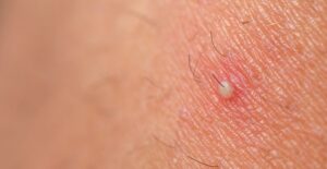 An ingrown hair appears
