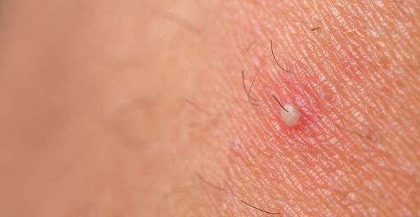 An ingrown hair appears
