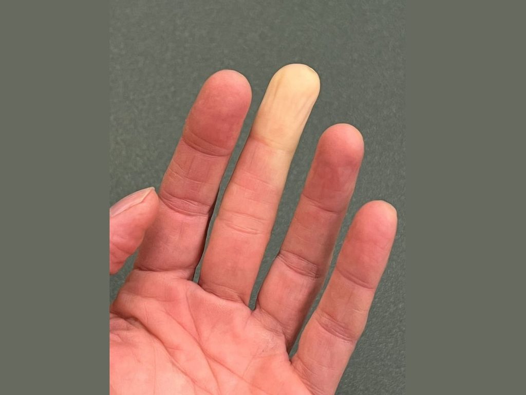 A man with poor circulation in his middle finger shows off how discolored his skin is.